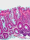 Hyperplastic polyp1.jpg