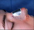 RhinoplastySplint3.jpg