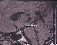 Adenome hypophyse.JPG