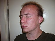 Angioedema.jpg