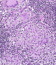 CD Granuloma.jpg