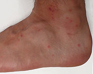 Chigger bites.jpg