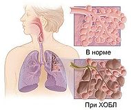 Copd rus.JPG