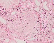 Crescentic glomerulonephritis HE stain.JPEG
