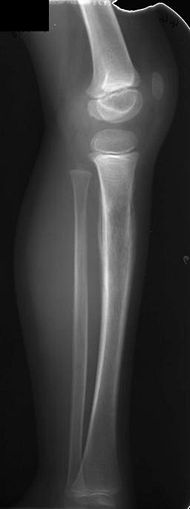 Ewing sarcoma tibia child.jpg