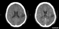 Glioma.gif