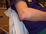 GoutTophiElbow.JPG
