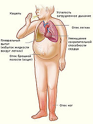 Heartfailure ru.jpg