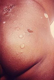 Impetigo.jpg