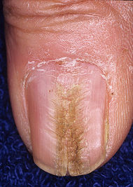 Mediannaildystrophy.jpg