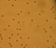 MicroHematuria.JPG