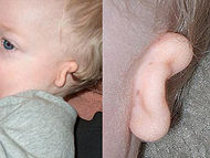 Microtia lvl3.jpg