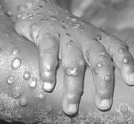 Monkeypox.jpg