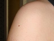 Nevus.jpg