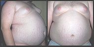 Obesity6.JPG