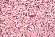 Osteosarcoma.jpg