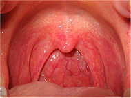 Pharyngitis.jpg