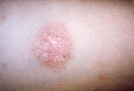 Pityriasis rosea.JPG