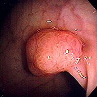 Polyp.jpeg