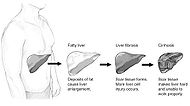 Stage of liver damage.JPG