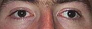 Strabismus.jpg