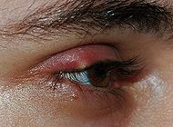 Stye02.jpg