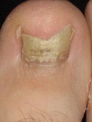 Toefungus.jpg