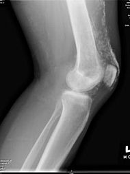 XRaydermatomyositis.jpg