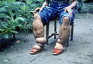 Elephantiasis.jpg