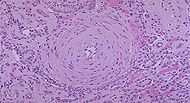 Hypertension_micro.jpg‎