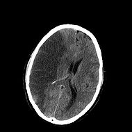 INFARCT.jpg