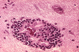 Rabies encephalitis PHIL 3368 lores.jpg